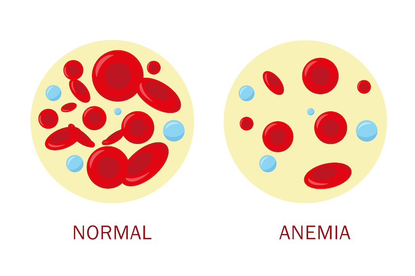 What Causes Anemia?